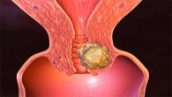 Rahim kanserleri  sıklıkla menopoz sonrası dönemde görülüyor